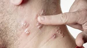 clindamycin-1-gel-targeted-relief-for-acne-management-big-0